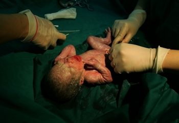 Китай стоит на первом месте по количеству кесаревых сечений. Фото: China Photos/Getty Images