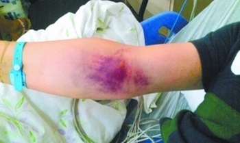 В результате отравления крысиным ядом, на теле Вана появились крупные кровяные пятна. Фото с epochtimes.com