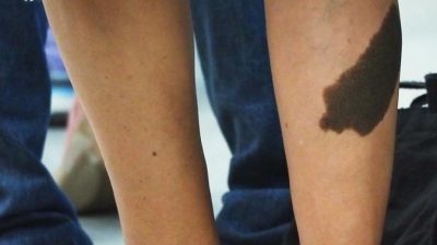 Почему родимые пятна появляются на месте ран, полученных в прошлой жизни