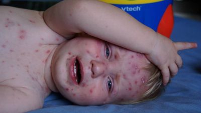 Ветрянка бьёт рекорды: заболеваемость удвоилась в ряде регионов РФ