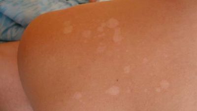 Белые пятна на теле: поспешите к дерматологу