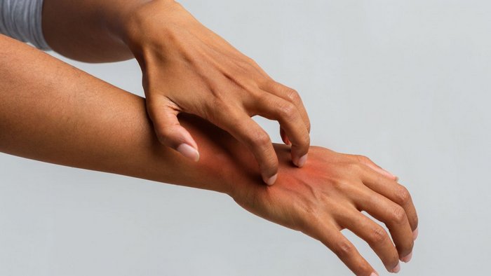 Псориаз. Фото: sovetnika.net | Epoch Times Россия