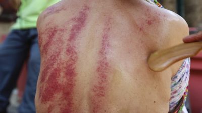 Массаж Гу-Ша. CHINESE MEDICINE