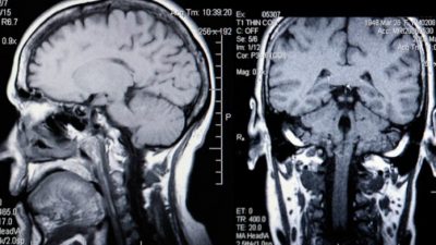 Диабет снижает умственные функции человека