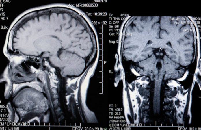 Исследователи находят всё больше доказательств того, что диабет влияет не только на тело, но и на мозг. Katrina Brown via Dreamstime 
