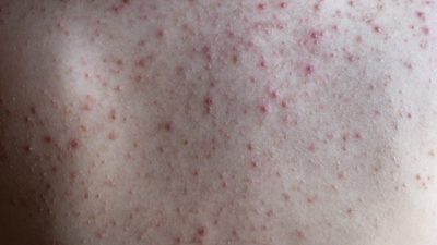 Всё, что нужно знать, чтобы избавиться от прыщей на спине
