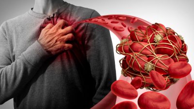 Проблема тромбоза