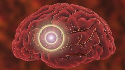 Остерегайтесь этих признаков тромботического инсульта