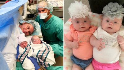 Как быть мамой монозиготных близнецов с синдромом Дауна