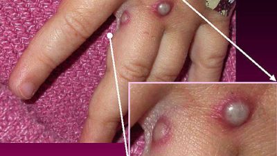 В России выявили первый случай оспы обезьян