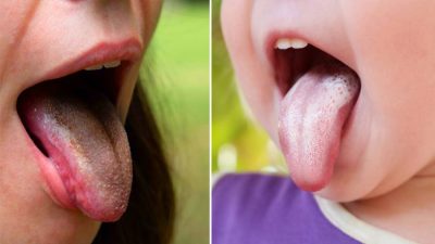 Что ваш язык говорит о вашем здоровье: 13 знаков