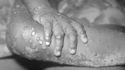 Врач предупреждает о подозрительной закономерности вспышки оспы обезьян