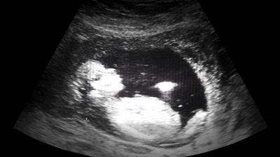 Последствия политики «одного ребёнка» в Китае