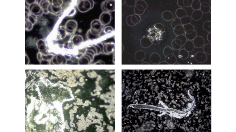Немецкие учёные обнаружили токсичные металлы в вакцинах от COVID-19 Эти 4 изображения иллюстрируют инородные компоненты, обнаруженные в крови людей, вакцинированных препаратом Comirnaty BioNTech/Pfizer. (Фото любезно предоставлено Хелен Кренн) | Epoch Times Россия