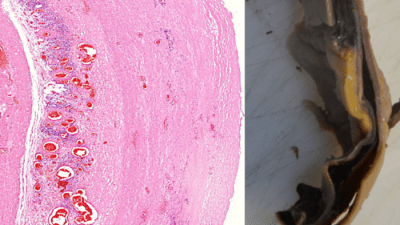 Учёные доказали, что мРНК-вакцины вызывают повреждение сосудов и органов