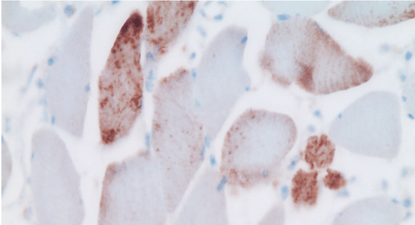 Поствакцинальные повреждения — это синдром, а не болезнь. Медики рассказали, как его лечить Поствакцинальные повреждения — это синдром, а не болезнь. Медики рассказали, как его лечить