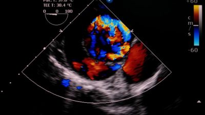 Расслоение аорты после вакцинации от COVID-19