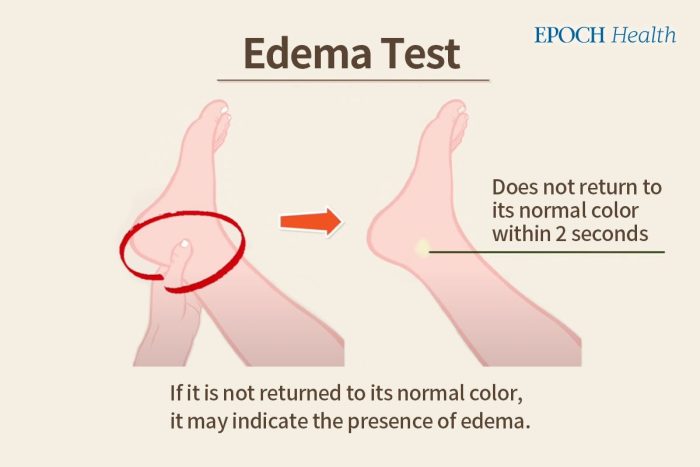Снижение отёчного веса методами массажа и акупрессуры на трёх акупунктурных точках